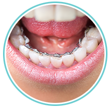 Lingual Braces